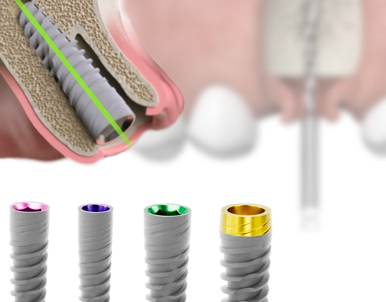 Implantes Dentales EVOLUTION PLUS: Tecnología de Vanguardia para tu Sonrisa