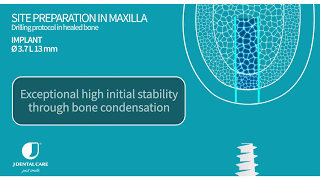 PREPARACIÓN DEL SITIO IMPLANTAR